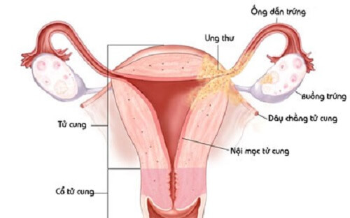 Điều trị viêm nội mạc cổ tử cung